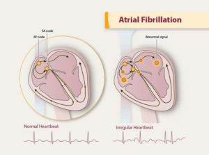 afib diagram